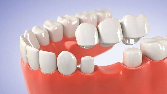 dental bridge