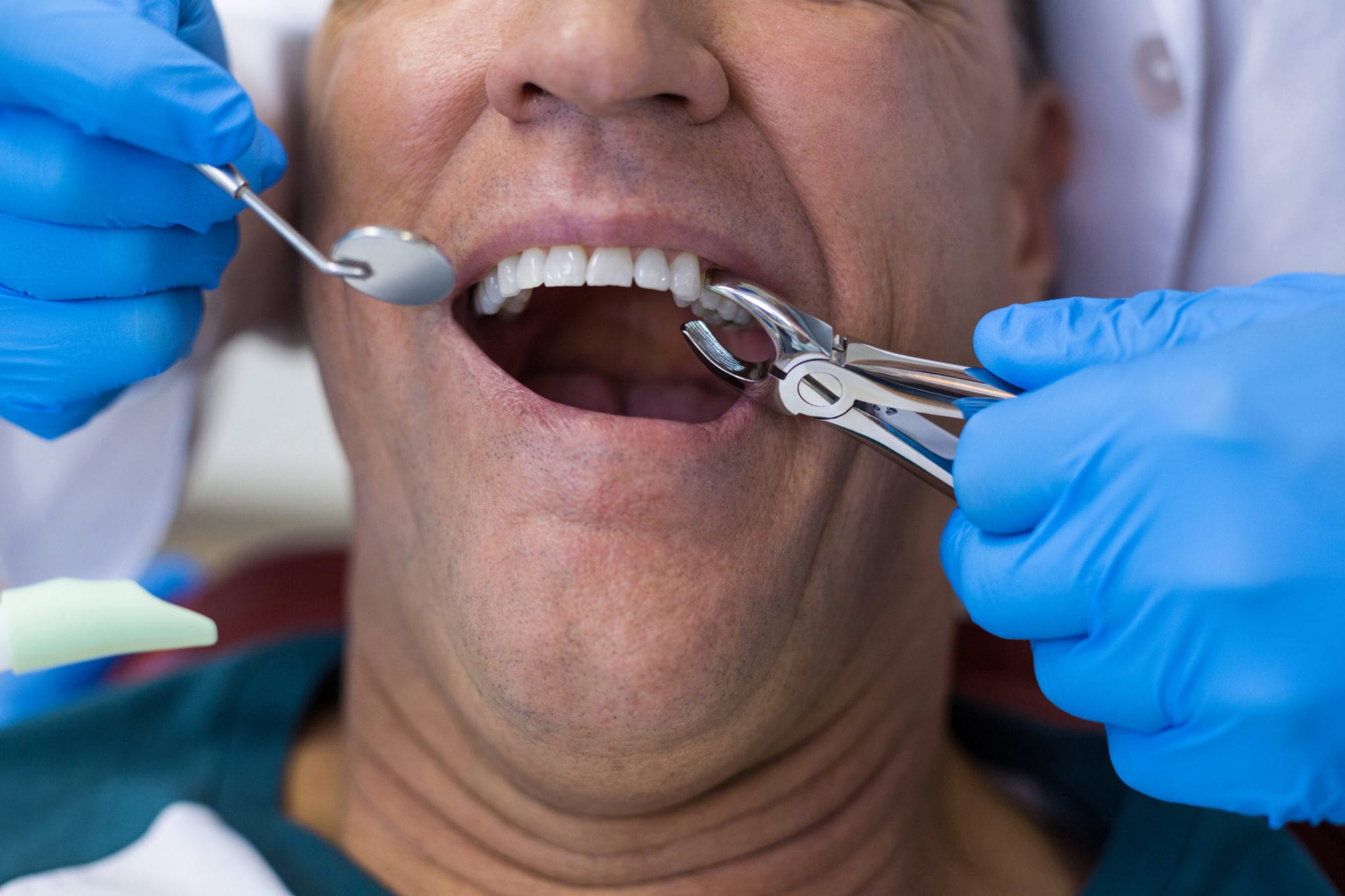 Tooth extraction in McAllen, Tx