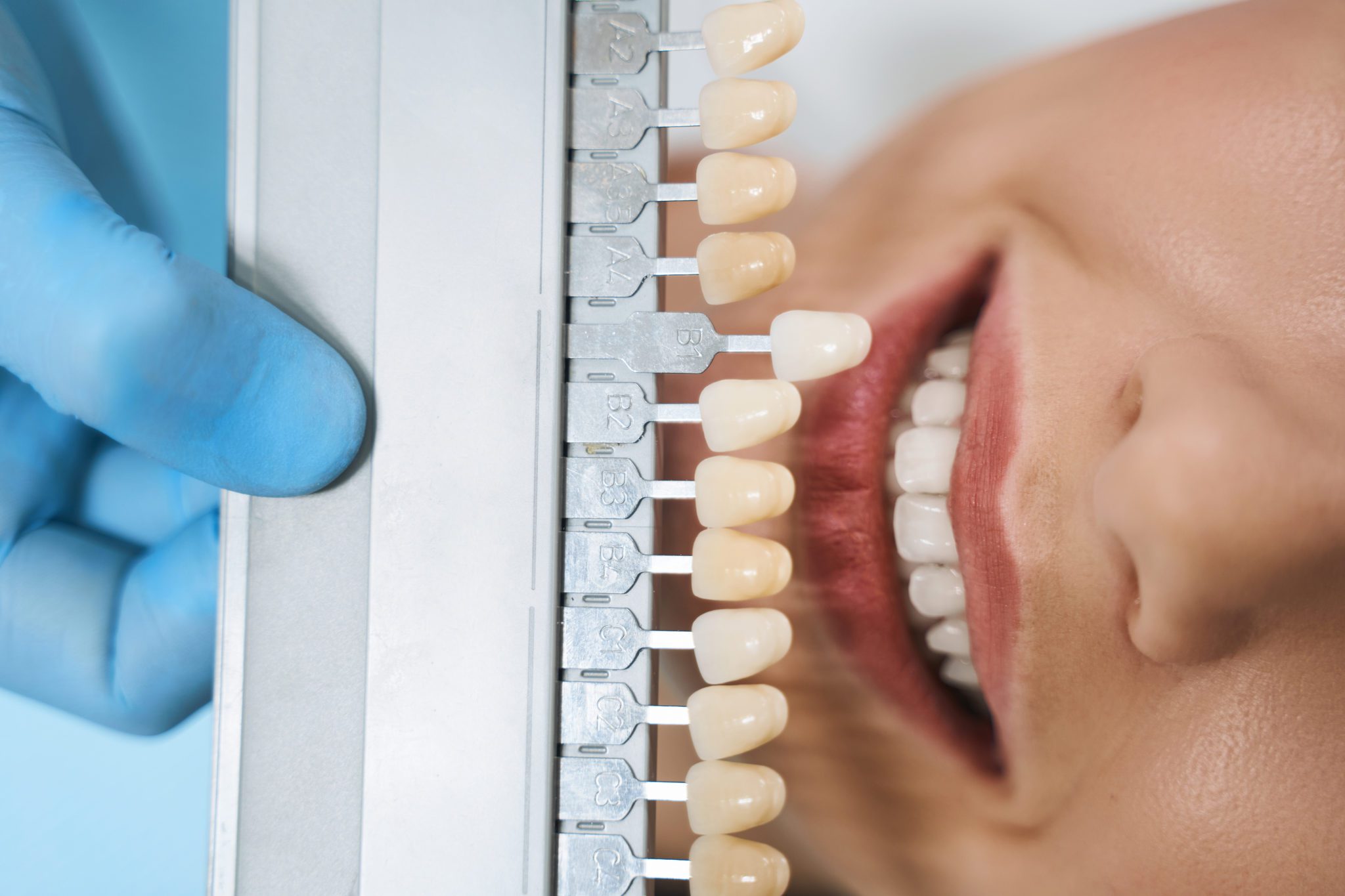 Veneers in Rio Grande Valley, Tx